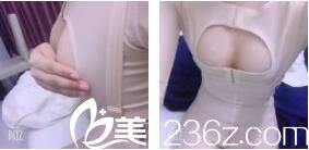 上海明桥整形美容门诊部金关键自体脂肪隆胸真人案例术后第三天