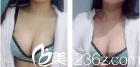 上海明桥整形美容门诊部金关键自体脂肪隆胸真人案例术后一个月