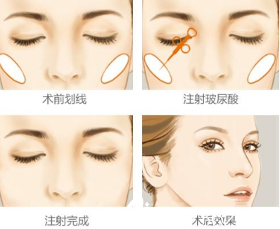 打玻尿酸贵不贵？选择长春莎图蕊注射玻尿酸3600元起就能做