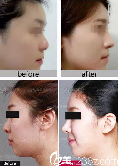 太原欧美莲雷雪华鼻整形失败修复效果对比图