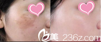 韩国S&U CLINIC整形医院激光祛斑案例