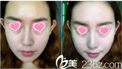 韩国S&U CLINIC整形医院效果