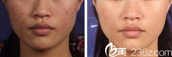 韩国S&U CLINIC整形医院祛痘案例