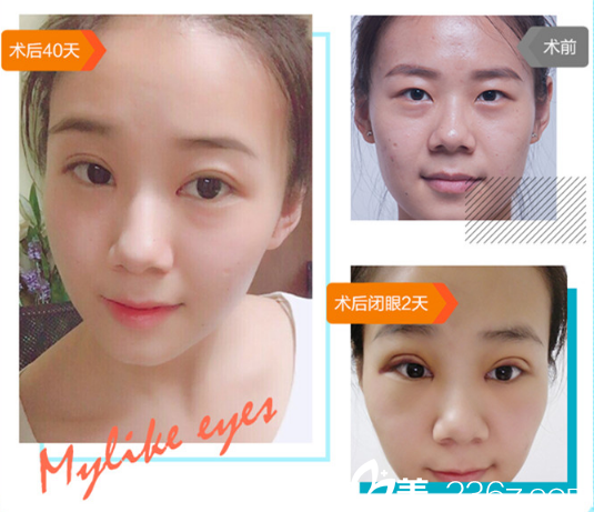 广州美莱医疗美容整形医院文科医生双眼皮开眼角案例图片 广州美莱医疗美容整形医院文科医生双眼皮开眼角案例图片