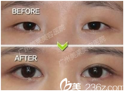 广州美莱整形美容医院金宪俊医生做的双眼皮案例图片