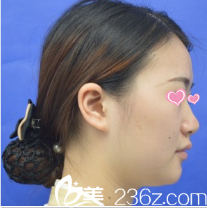 在韩国心美眼隆鼻术前照 在韩国心美眼隆鼻术前照