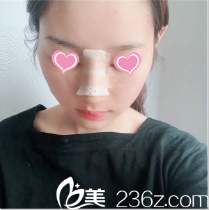 <!--<i data=20240703-sp></i>-->隆鼻案例术后4天效果 <!--<i data=20240703-sp></i>-->隆鼻案例术后4天效果