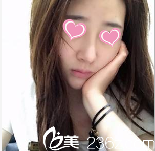 <!--<i data=20240703-sp></i>-->鼻综合案例术后35天样子 <!--<i data=20240703-sp></i>-->鼻综合案例术后35天样子