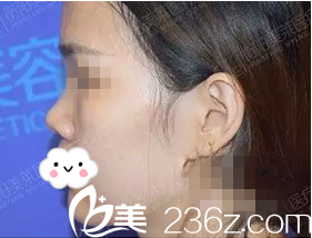 手术前侧面照 手术前侧面照