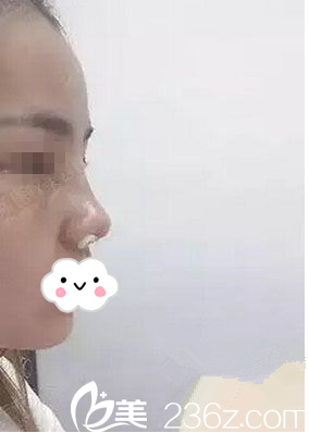 术后第七天 术后第七天