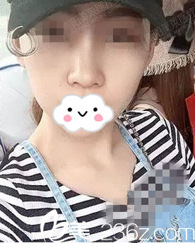 术后10天 术后10天