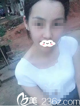 术后20天 术后20天