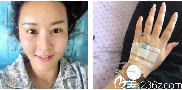 找广州华美郝永生做完脂肪填充和面部吸脂第二天 找广州华美郝永生做完脂肪填充和面部吸脂第二天