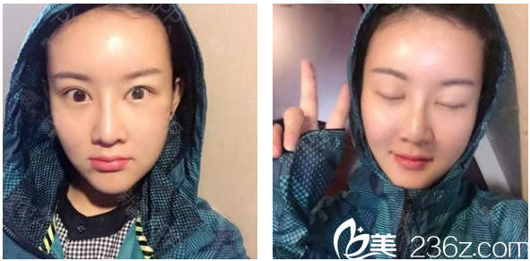 广州华美整形医院郝永生自体脂肪面部填充术后半个月吸收效果图 广州华美整形医院郝永生自体脂肪面部填充术后半个月吸收效果图