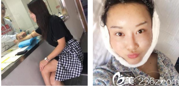 广州华美郝永生自体脂肪全脸填充术后即刻效果图 广州华美郝永生自体脂肪全脸填充术后即刻效果图