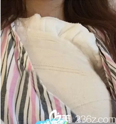 刚做完假体隆胸术后肿胀期 刚做完假体隆胸术后肿胀期