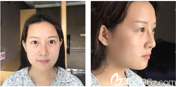 来广州华美做自体脂肪面部填充前的照片 来广州华美做自体脂肪面部填充前的照片