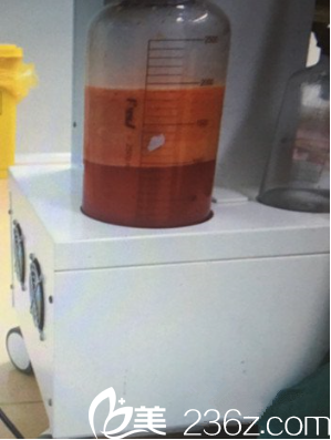 吸出来的脂肪 吸出来的脂肪