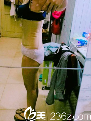 <!--<i data=20240703-sp></i>-->整形腰腹吸脂术后第五天 <!--<i data=20240703-sp></i>-->整形腰腹吸脂术后第五天