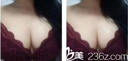 上海宏仁医疗美容诊所陆毅自体脂肪隆胸真人案例术后一个月