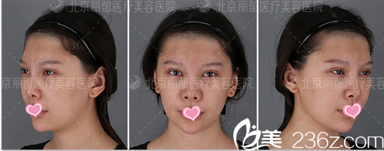 在北京丽都找高超医生做鼻综合之前照