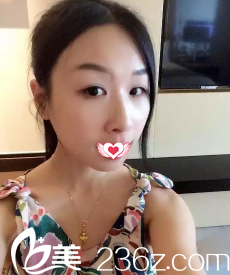 术前单眼皮 术前单眼皮