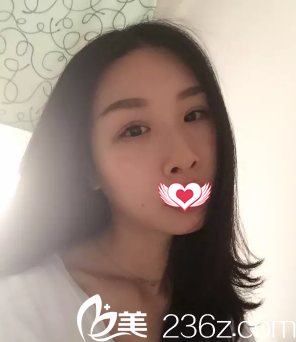 术后7天双眼皮拆完线的样子 术后7天双眼皮拆完线的样子