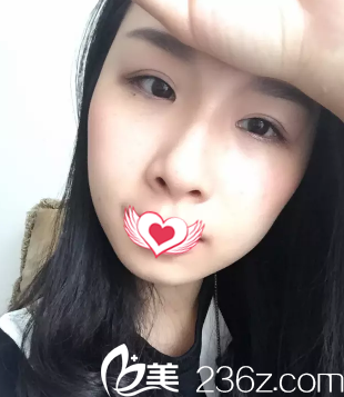 15天双眼皮恢复的款窄适中 15天双眼皮恢复的款窄适中