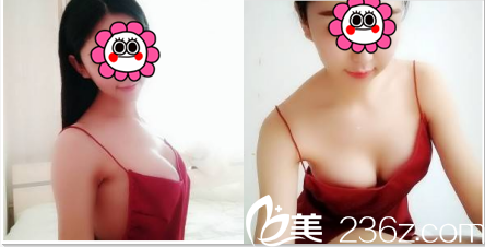 北京美莱黄杰假体隆胸案例