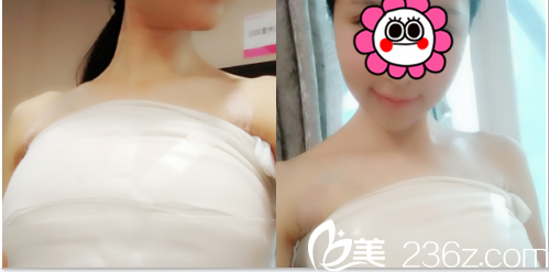 北京美莱假体隆胸案例术后第4天效果
