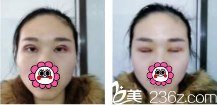 上海华侨医疗美容门诊部莫建民双眼皮真人案例术后第三天