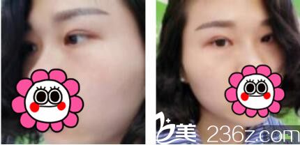 上海华侨医疗美容门诊部莫建民双眼皮真人案例术后一个月
