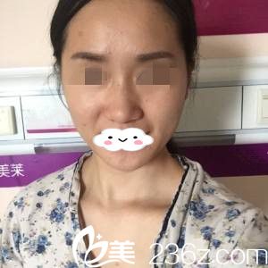 手术前的我 手术前的我