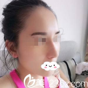 鼻综合手术拆线当天 鼻综合手术拆线当天