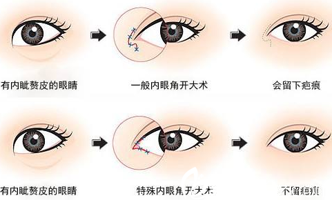 大同美神整形美容诊所开眼角科普图