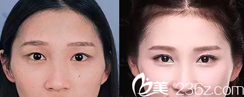大同美神整形美容医院开眼角前后效果对比图