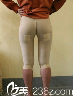 张宝誉大腿吸脂术后14天