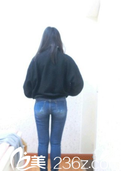 新疆伊丽莎白整形大腿吸脂术后一个月