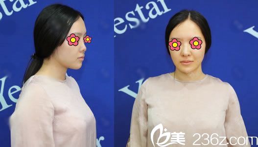 到杭州瑞丽做隆鼻前 到杭州瑞丽做隆鼻前