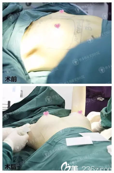 隆胸术前术后即刻对比照片