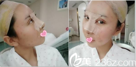 北京美莱眼修复和鼻综合案例第5天样子