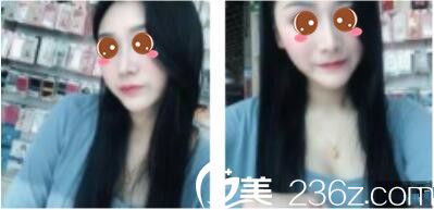 公布我在上海原辰找李科做的鼻综合三个月的恢复照，想变美原来这么简单