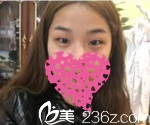 术前是肿泡眼 术前是肿泡眼