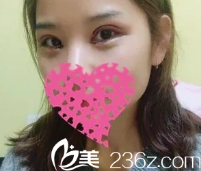 刚做完手术双眼皮微肿 刚做完手术双眼皮微肿