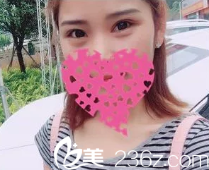 恢复18天的双眼皮肿胀全消 恢复18天的双眼皮肿胀全消