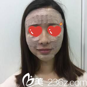 面部脂肪填充第三天