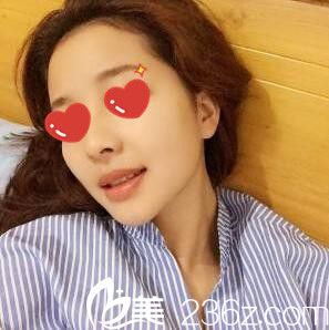 全脸脂肪填充1个月