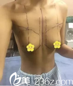 去贵阳美莱医院面诊的我 去贵阳美莱医院面诊的我