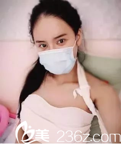 梁洁假体丰胸术后6天 梁洁假体丰胸术后6天