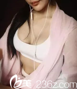 贵阳美莱假体丰胸术后17天 贵阳美莱假体丰胸术后17天
